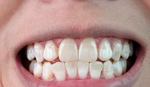 Improvement of Teeth White Spots