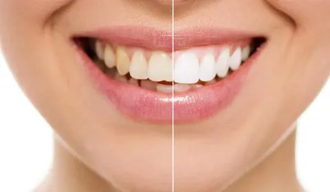 Teeth Whitening