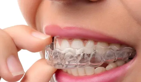 Invisalign