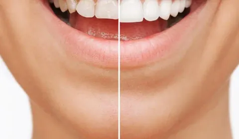 Veneers