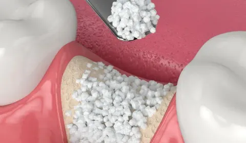 Bone Grafting
