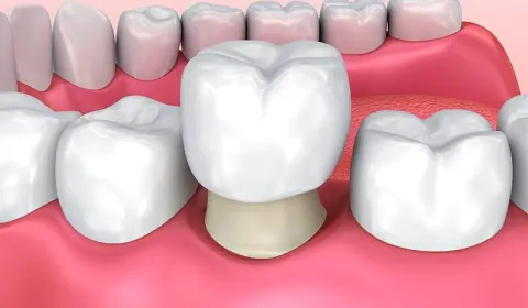 Crowns