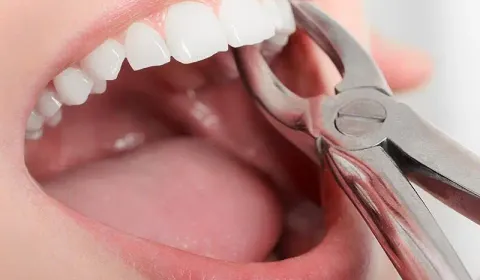 Tooth Extractions