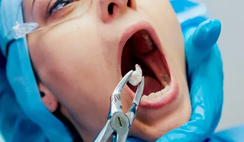 Wisdom Teeth Extractions