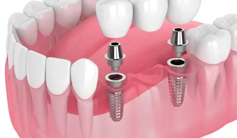 Implant-Supported Bridge