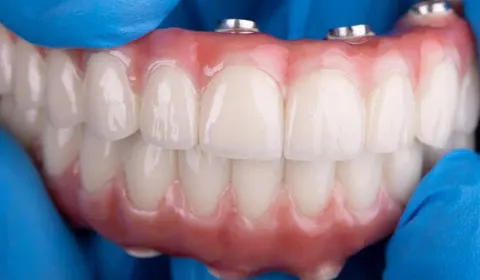 Implant-Supported Dentures