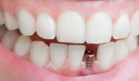 Single Tooth Implants