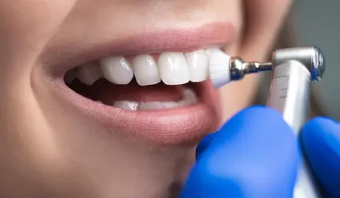 Teeth Cleaning