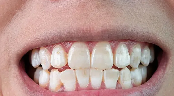 Improvement of Teeth White Spots