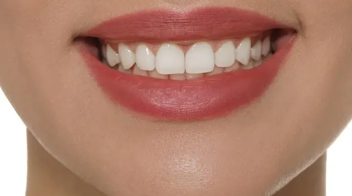 Smile Design