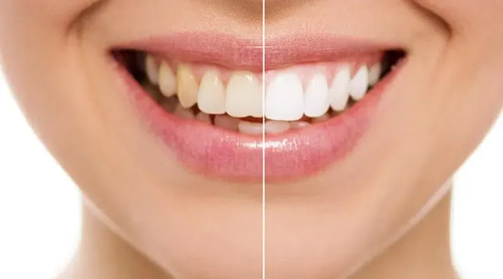 Teeth Whitening