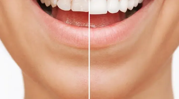 Veneers
