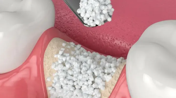 Bone Grafting