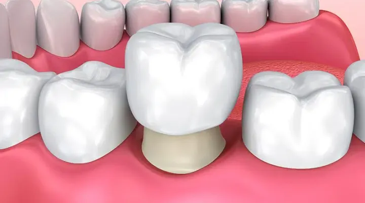 Crowns