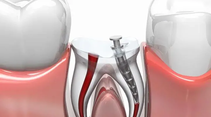 Root Canal