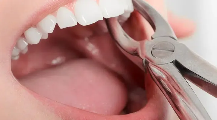 Tooth Extractions