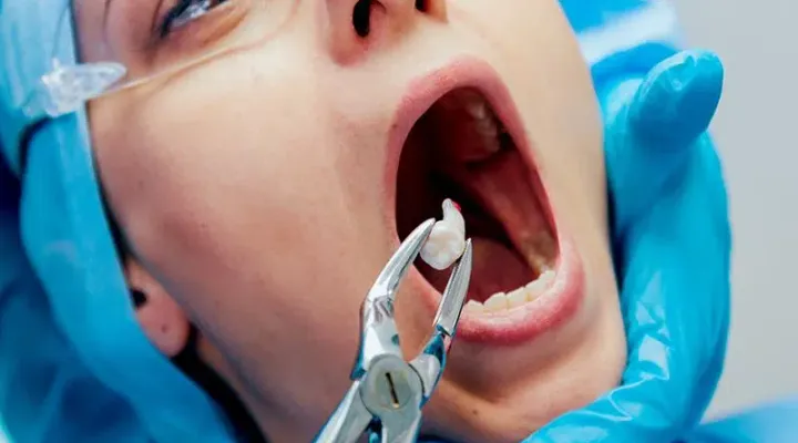 Wisdom Teeth Extractions