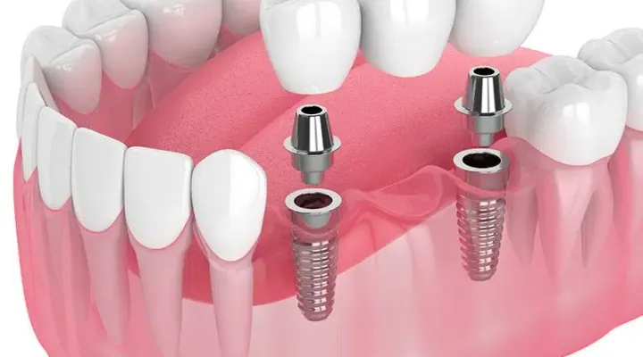 Implant-Supported Bridge