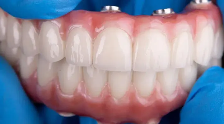Implant-Supported Dentures