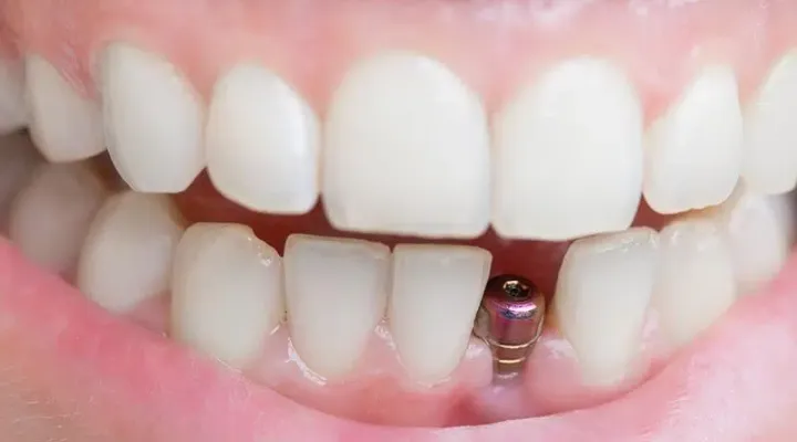 Single Tooth Implants